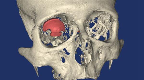 3D打印技術在醫療方面的應用 世界首個3D打印義眼_E鍵3D打印服務 3D打印技術在醫療方面的應用 世界首個3D打印義眼_E鍵3D打印服務