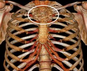 第四軍醫(yī)大學(xué)精彩分享個性化醫(yī)療3D打印的實戰(zhàn)案例與研究成果 第四軍醫(yī)大學(xué)精彩分享個性化醫(yī)療3D打印的實戰(zhàn)案例與研究成果