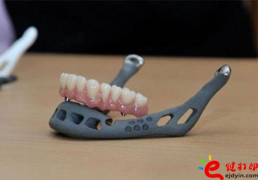 3D打印牙嵌體和牙套哪種更好?3D打印牙齒/隱形牙套/牙冠/模型/成品價格表 3D打印牙嵌體和牙套哪種更好?3D打印牙齒/隱形牙套/牙冠/模型/成品價格表
