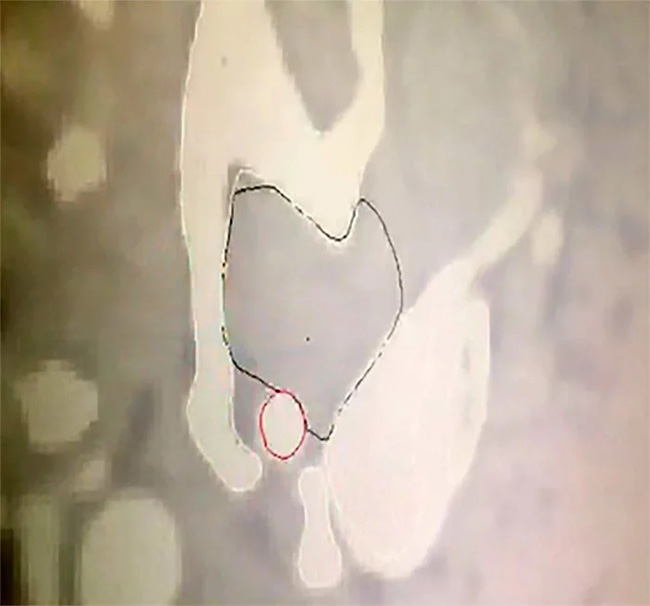 術(shù)前CT骨腫瘤位置圖