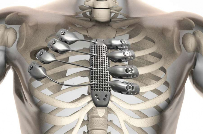 3D打印醫療器械將在我國迎來蓬勃發展