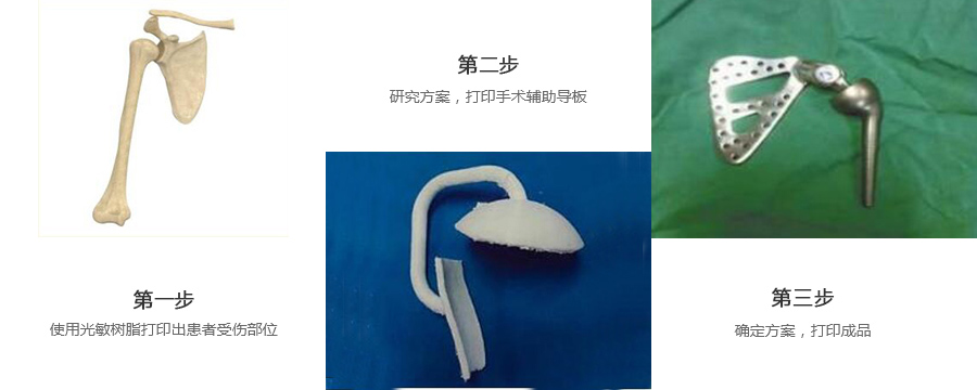 肩關節金屬植入物3d打印制作流程